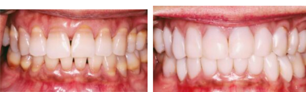 Bioclear Before and After image
