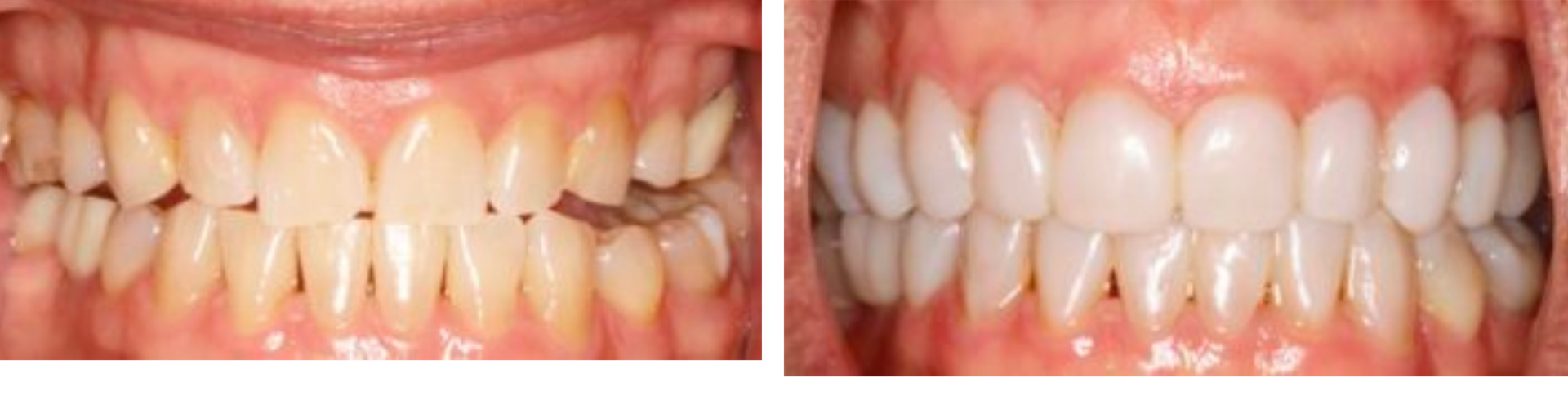 Bioclear Before and After photo